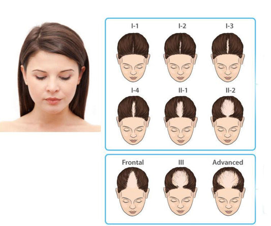 Ursachen der androgenetischen Alopezie