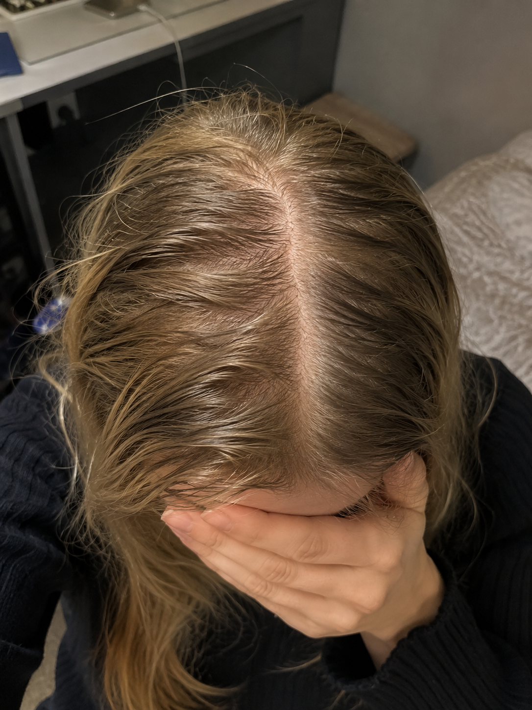 Vorher Nachher Ergebnis einer Frau mit diffusem Haarausfall und breitem Scheitel