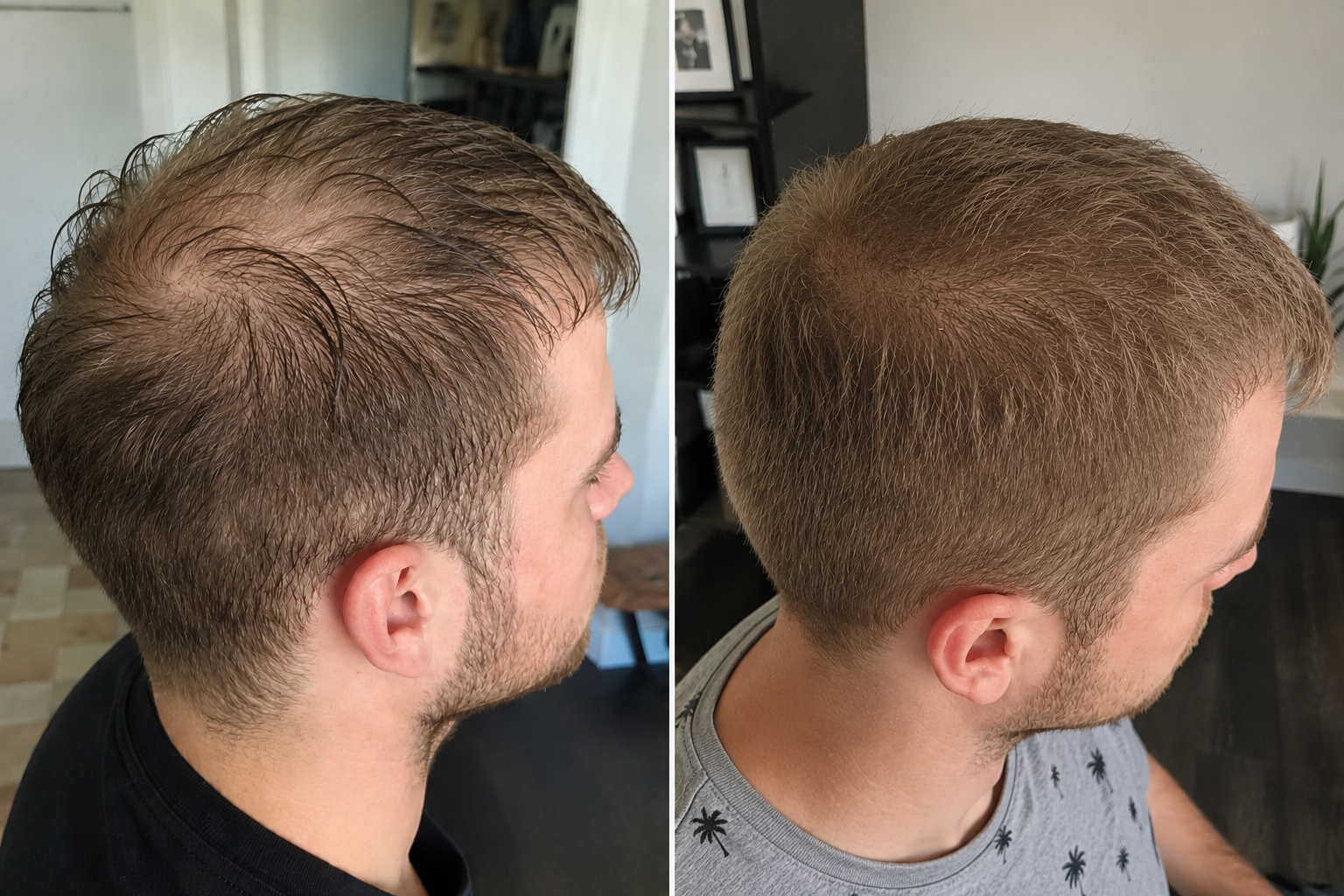 Vorher Nachher Foto eines Mannes mit Geheimratsecken und Tonsur Haarausfall nach Haarwachstum Behandlung